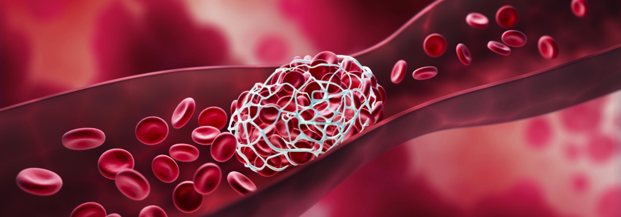 Blood clot blocking a blood vessel and blood stream - 3D illustration