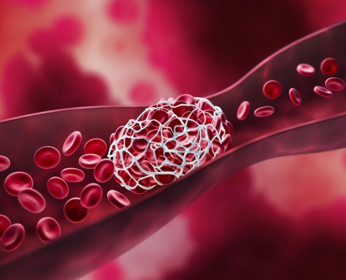 Blood clot blocking a blood vessel and blood stream - 3D illustration