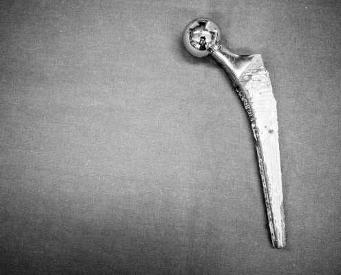 explanted hip prosthesis was cleaned and lies on a green surgical drape