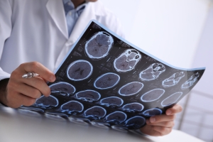 Doctor examining MRI images of patient with multiple sclerosis at table in clinic, closeup